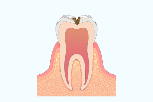 象牙質に到達した虫歯